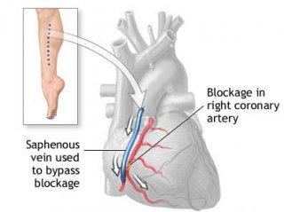 Coronary artery bypass graft