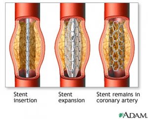 Coronarystent